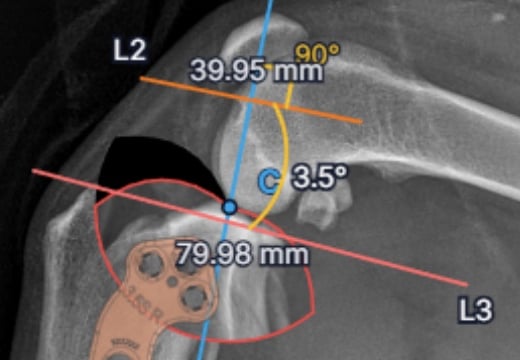 Close-up of an osAlign TPLO plan showing measurements of 39.95 millimeters and 79.98 millimeters and a leveled plateau angle of 3.5 degrees