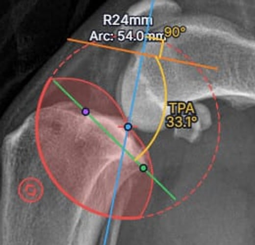 Close-up of an osAlign saw cut circle with a 24 millimeter radius and 54.0 millimeter arc over a canine proximal tibia with TPA 33.1 degrees