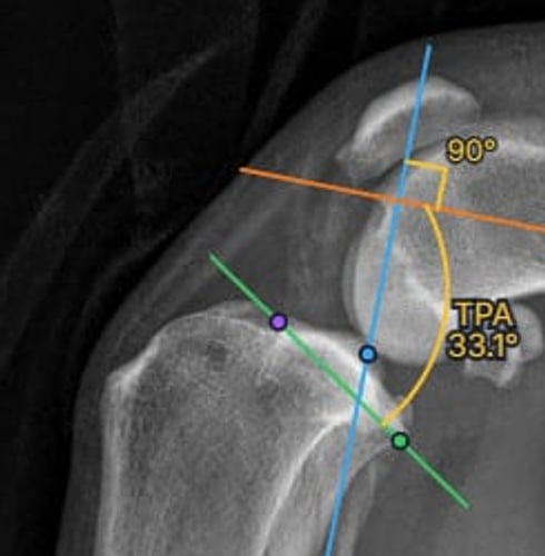 Close-up of the TPA construction in osAlign: plateau line, functional axis, 90 degree perpendicular, and a 33.1 degree angle