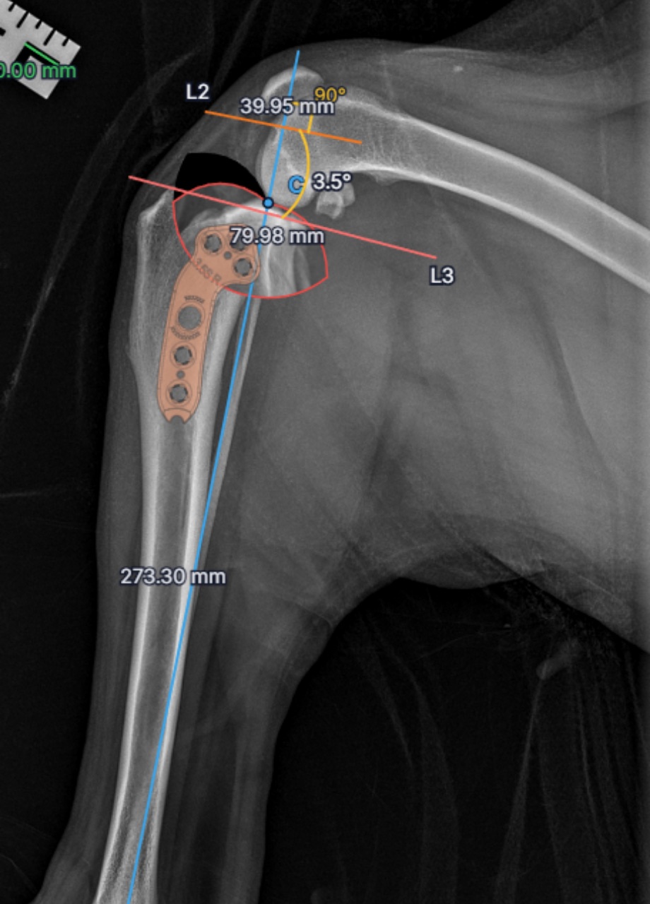 osAlign plan with anatomical landmarks, the tibial plateau angle, the osteotomy, and a plate overlay