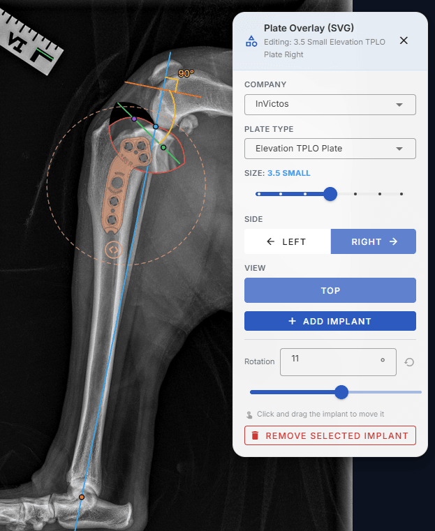 Plate overlay tool with a manufacturer plate SVG aligned on the proximal tibia
